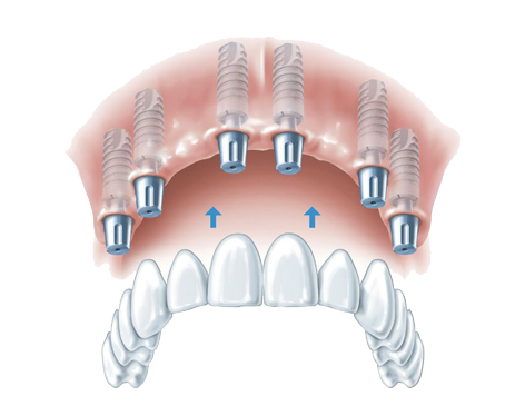 Zahnersatz auf 6 Implantaten